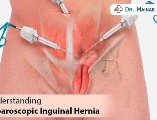 Understanding Laparoscopic Inguinal Hernia Surgery